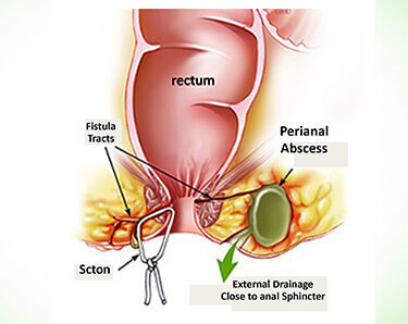 Fistula