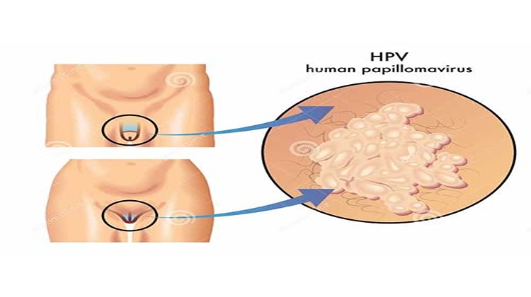 Genital Warts HPV