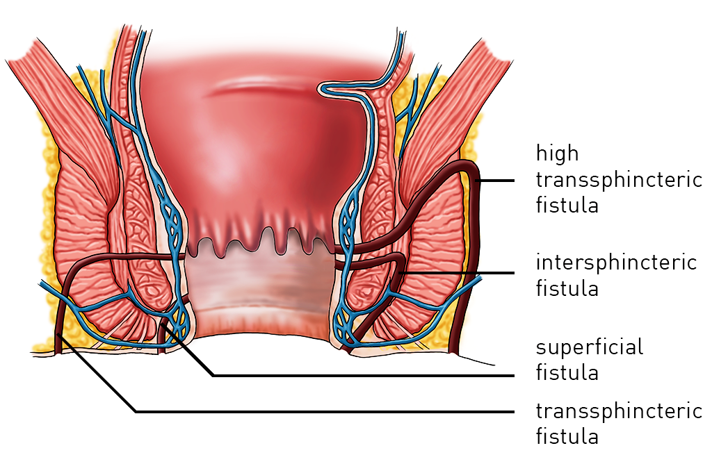 fistual