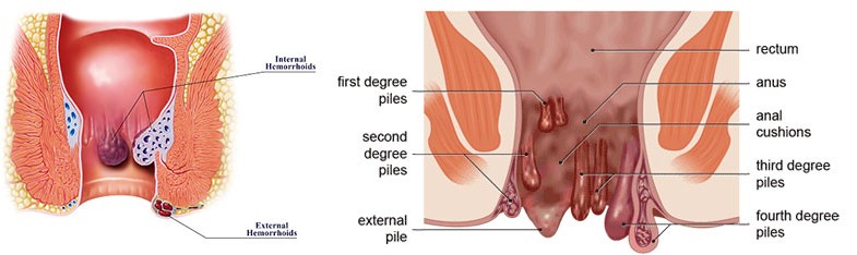 hemorrhoids