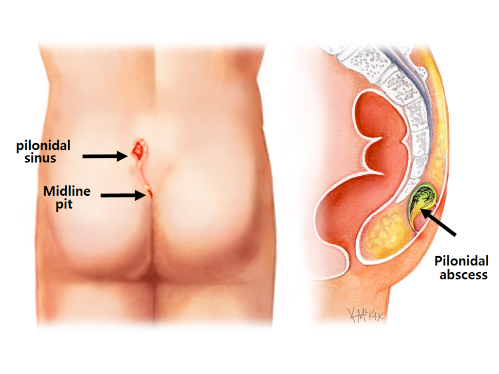 pilonidal-sinus